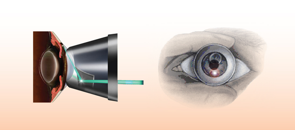 青光眼,希瑪瑞視眼科,上海眼科醫(yī)院 青光眼,希瑪瑞視眼科,上海眼科醫(yī)院