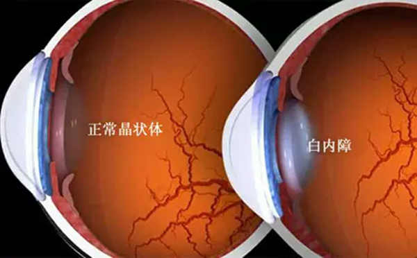 白內障,希瑪瑞視眼科,上海眼科醫院 白內障,希瑪瑞視眼科,上海眼科醫院