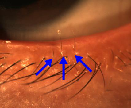 小兒眼病,希瑪瑞視眼科,上海眼科醫院