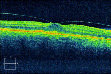玻璃體視網膜,希瑪瑞視眼科,上海眼科醫院