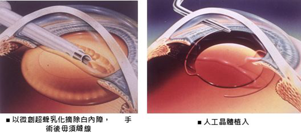 青光眼,希瑪瑞視眼科,上海眼科醫院 青光眼,希瑪瑞視眼科,上海眼科醫院