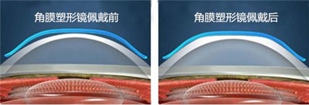 屈光矯視,希瑪瑞視眼科,上海眼科醫院