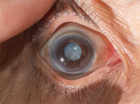 白內障,?，斎鹨曆劭?上海眼科醫院