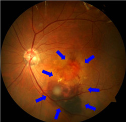 玻璃體視網(wǎng)膜