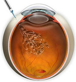 玻璃體視網(wǎng)膜