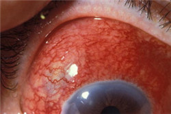 眼表眼角膜,希瑪瑞視眼科,上海眼科醫院