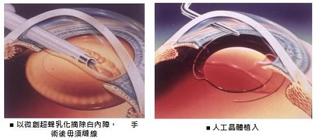 白內(nèi)障,希瑪瑞視眼科,上海眼科醫(yī)院 白內(nèi)障,希瑪瑞視眼科,上海眼科醫(yī)院