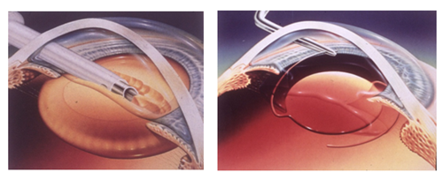 青光眼,希瑪瑞視眼科,上海眼科醫院 青光眼,希瑪瑞視眼科,上海眼科醫院