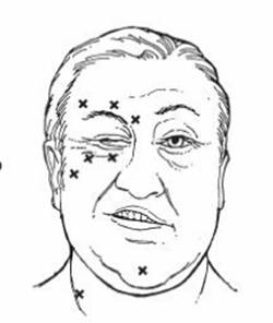 眼眶病,希瑪瑞視眼科,上海眼科醫(yī)院 眼眶病,希瑪瑞視眼科,上海眼科醫(yī)院