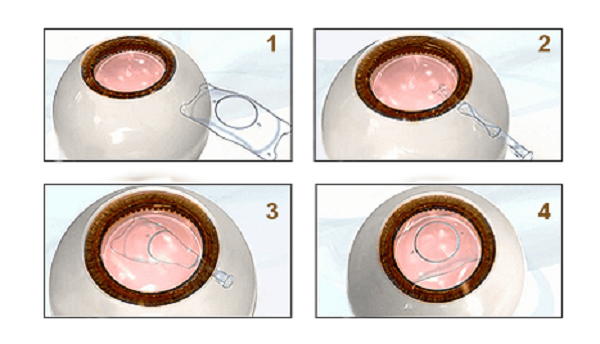 屈光矯視,希瑪瑞視眼科,上海眼科醫(yī)院 屈光矯視,希瑪瑞視眼科,上海眼科醫(yī)院