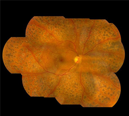 玻璃體視網膜,希瑪瑞視眼科,上海眼科醫院 玻璃體視網膜,希瑪瑞視眼科,上海眼科醫院