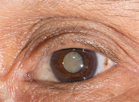 白內(nèi)障,希瑪瑞視眼科,上海眼科醫(yī)院 白內(nèi)障,希瑪瑞視眼科,上海眼科醫(yī)院