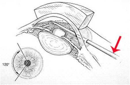 青光眼,希瑪瑞視眼科,上海眼科醫院