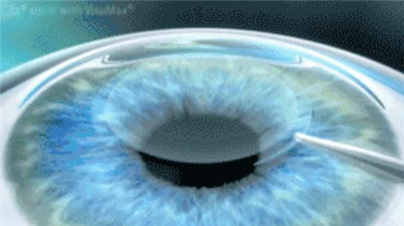 屈光矯視,希瑪瑞視眼科,上海眼科醫院 屈光矯視,希瑪瑞視眼科,上海眼科醫院