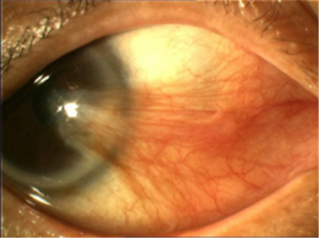 眼表眼角膜,希瑪瑞視眼科,上海眼科醫院 眼表眼角膜,希瑪瑞視眼科,上海眼科醫院