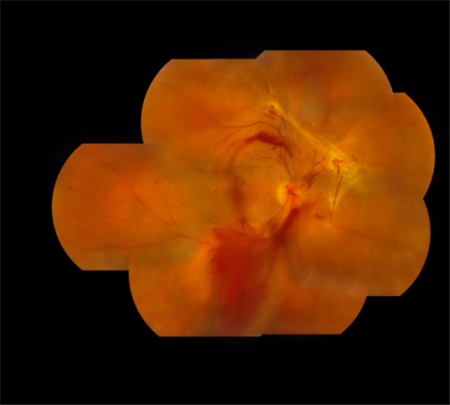 玻璃體視網膜,希瑪瑞視眼科,上海眼科醫院 玻璃體視網膜,希瑪瑞視眼科,上海眼科醫院