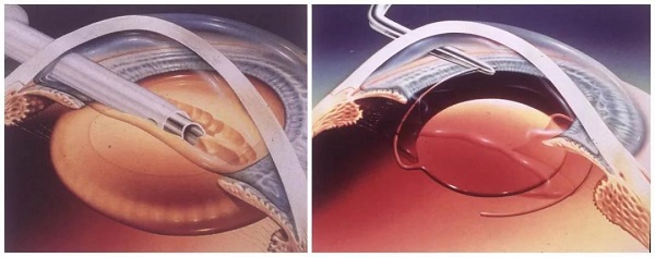 白內(nèi)障,希瑪瑞視眼科,上海眼科醫(yī)院 白內(nèi)障,希瑪瑞視眼科,上海眼科醫(yī)院