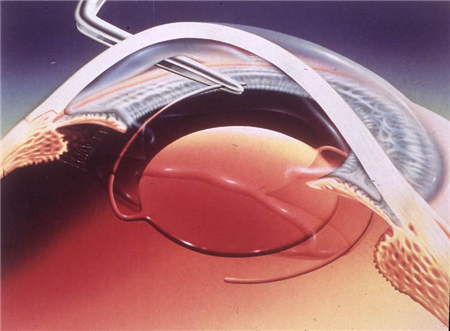 白內(nèi)障,希瑪瑞視眼科,上海眼科醫(yī)院 白內(nèi)障,希瑪瑞視眼科,上海眼科醫(yī)院