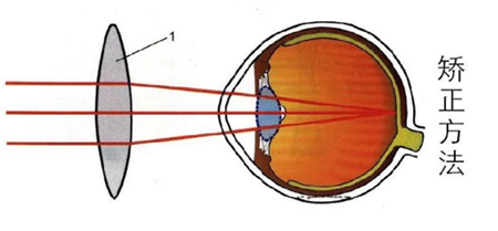 屈光矯視,希瑪瑞視眼科,上海眼科醫院