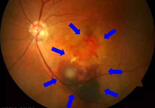玻璃體視網(wǎng)膜
