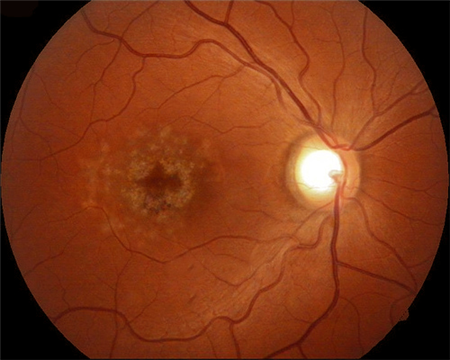 玻璃體視網(wǎng)膜