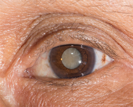 白內障,希瑪瑞視眼科,上海眼科醫院 白內障,希瑪瑞視眼科,上海眼科醫院