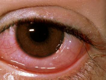 眼表眼角膜,希瑪瑞視眼科,上海眼科醫(yī)院 眼表眼角膜,希瑪瑞視眼科,上海眼科醫(yī)院