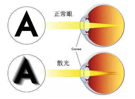 屈光矯視,希瑪瑞視眼科,上海眼科醫院 屈光矯視,希瑪瑞視眼科,上海眼科醫院
