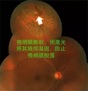 玻璃體視網膜,希瑪瑞視眼科,上海眼科醫院 玻璃體視網膜,希瑪瑞視眼科,上海眼科醫院