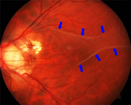 玻璃體視網膜,希瑪瑞視眼科,上海眼科醫院 玻璃體視網膜,希瑪瑞視眼科,上海眼科醫院
