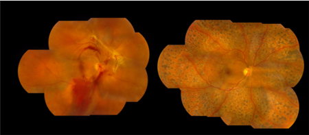 玻璃體視網膜,希瑪瑞視眼科,上海眼科醫院