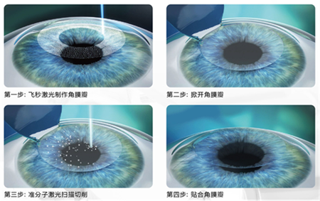 屈光矯視,希瑪瑞視眼科,上海眼科醫院