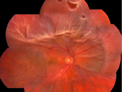 玻璃體視網(wǎng)膜,希瑪瑞視眼科,上海眼科醫(yī)院 玻璃體視網(wǎng)膜,希瑪瑞視眼科,上海眼科醫(yī)院