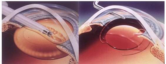 青光眼,希瑪瑞視眼科,上海眼科醫(yī)院 青光眼,希瑪瑞視眼科,上海眼科醫(yī)院