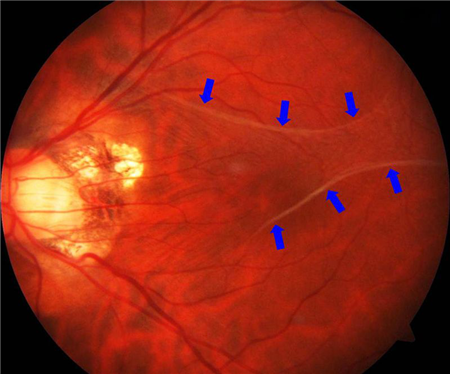 玻璃體視網(wǎng)膜