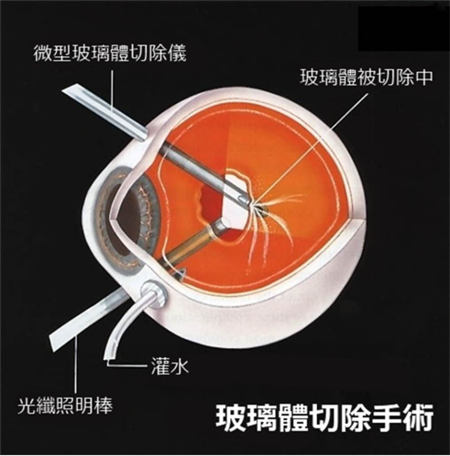 玻璃體視網(wǎng)膜