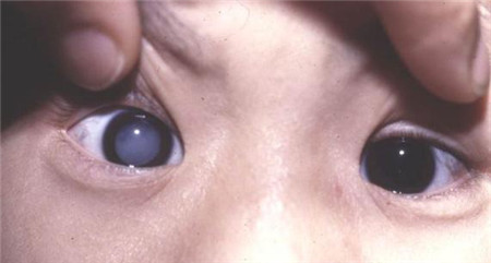 白內(nèi)障,希瑪瑞視眼科,上海眼科醫(yī)院 白內(nèi)障,希瑪瑞視眼科,上海眼科醫(yī)院