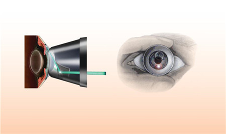 青光眼,希瑪瑞視眼科,上海眼科醫(yī)院