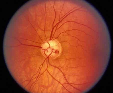 青光眼,希瑪瑞視眼科,上海眼科醫院 青光眼,希瑪瑞視眼科,上海眼科醫院