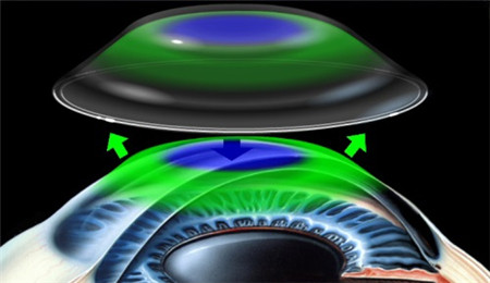 屈光矯視,希瑪瑞視眼科,上海眼科醫院