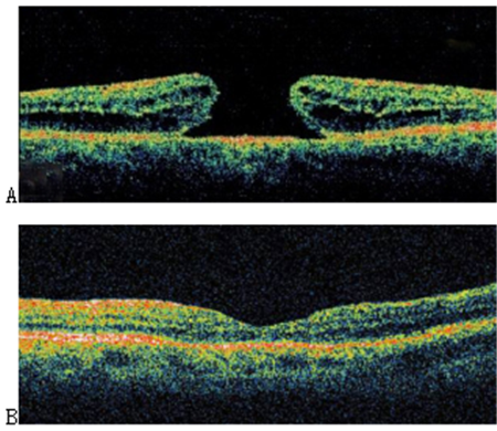 玻璃體視網膜,希瑪瑞視眼科,上海眼科醫院 玻璃體視網膜,希瑪瑞視眼科,上海眼科醫院