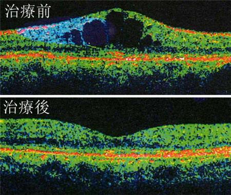 玻璃體視網膜,希瑪瑞視眼科,上海眼科醫院 玻璃體視網膜,希瑪瑞視眼科,上海眼科醫院