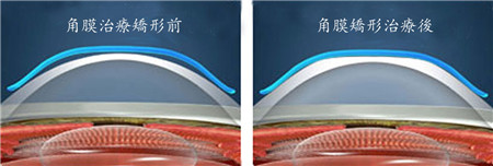 屈光矯視,希瑪瑞視眼科,上海眼科醫院