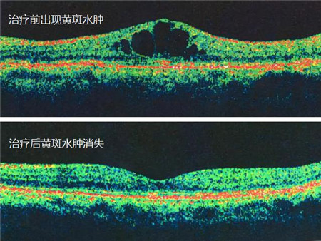 玻璃體視網膜,希瑪瑞視眼科,上海眼科醫院 玻璃體視網膜,希瑪瑞視眼科,上海眼科醫院