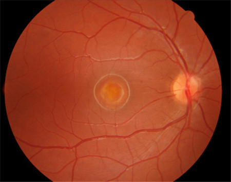 玻璃體視網膜,希瑪瑞視眼科,上海眼科醫院 玻璃體視網膜,希瑪瑞視眼科,上海眼科醫院