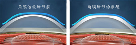 屈光矯視,希瑪瑞視眼科,上海眼科醫(yī)院 屈光矯視,希瑪瑞視眼科,上海眼科醫(yī)院