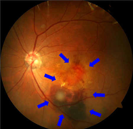 玻璃體視網膜,希瑪瑞視眼科,上海眼科醫院 玻璃體視網膜,希瑪瑞視眼科,上海眼科醫院