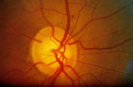 玻璃體視網膜,希瑪瑞視眼科,上海眼科醫院 玻璃體視網膜,希瑪瑞視眼科,上海眼科醫院