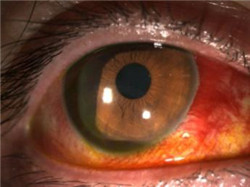 眼表眼角膜,希瑪瑞視眼科,上海眼科醫院 眼表眼角膜,希瑪瑞視眼科,上海眼科醫院