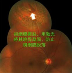 玻璃體視網(wǎng)膜,?，斎鹨曆劭?上海眼科醫(yī)院